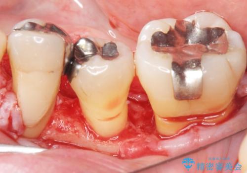 歯周病を治す 再生療法 50代男性の治療中
