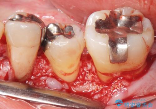 歯周病を治す 再生療法 50代男性