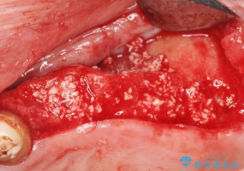 他院でインプラントできないと言われた 上顎洞底挙上術を併用したインプラント 50代男性の治療中