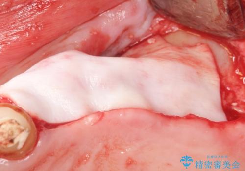 他院でインプラントできないと言われた 上顎洞底挙上術を併用したインプラント 50代男性の治療中