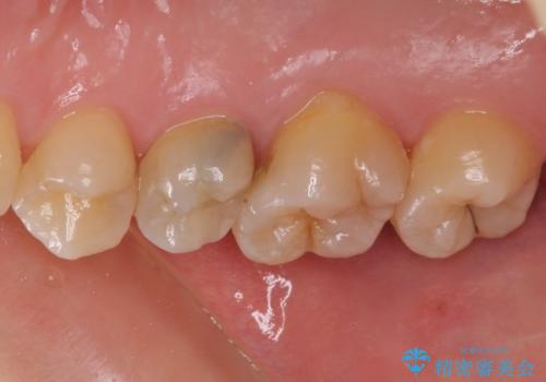 神経が死んで変色した歯 根管治療とオールセラミッククラウンの治療前