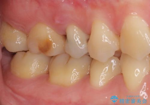 神経が死んで変色した歯 根管治療とオールセラミッククラウンの治療前