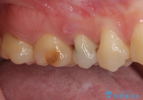神経が死んで変色した歯 根管治療とオールセラミッククラウンの治療前
