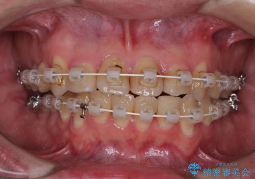 歯列全体のクロスバイトを治したい　ワイヤー装置による矯正治療の治療中