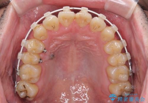 歯列全体のクロスバイトを治したい　ワイヤー装置による矯正治療の治療中