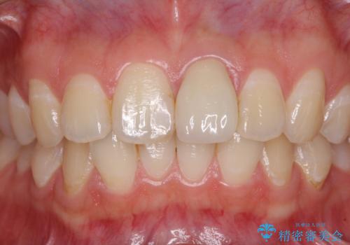 出っ歯に仕上がってしまった前歯 セラミッククラウンの作り替えの治療前