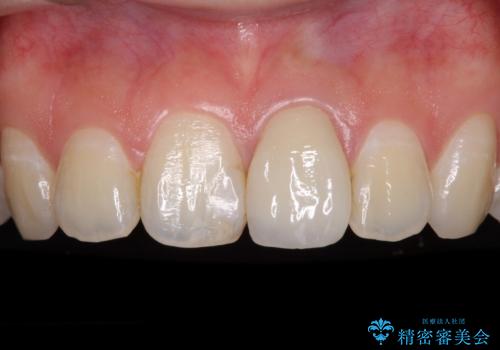 出っ歯に仕上がってしまった前歯 セラミッククラウンの作り替えの治療前