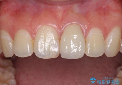 出っ歯に仕上がってしまった前歯 セラミッククラウンの作り替えの治療前