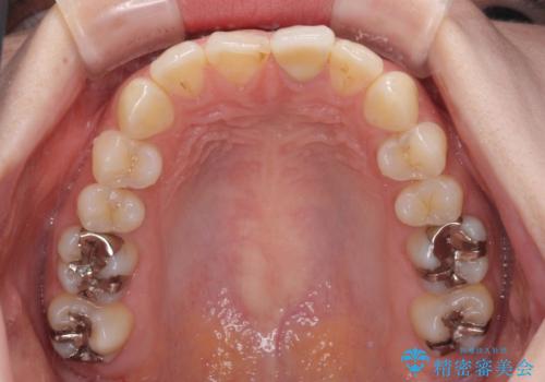 出っ歯に仕上がってしまった前歯 セラミッククラウンの作り替えの治療前