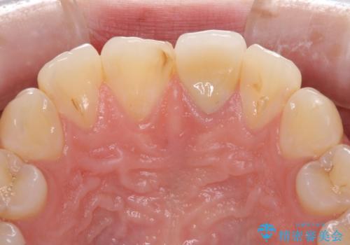 出っ歯に仕上がってしまった前歯 セラミッククラウンの作り替えの症例 治療前