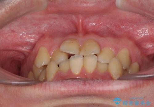 歯列全体のクロスバイトを治したい　ワイヤー装置による矯正治療の治療前