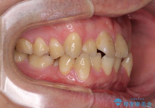 歯列全体のクロスバイトを治したい　ワイヤー装置による矯正治療の治療前
