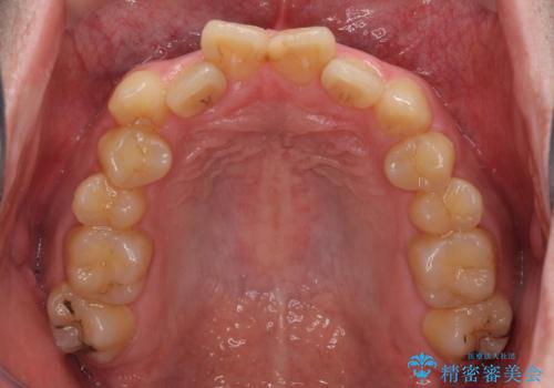 歯列全体のクロスバイトを治したい ワイヤー装置による矯正治療の治療前