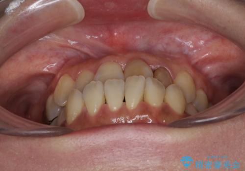 反対咬合で痛む前歯を改善 インビザラインによる矯正治療の治療前