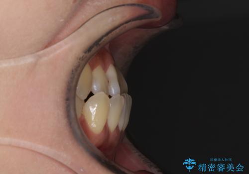 反対咬合で痛む前歯を改善 インビザラインによる矯正治療の治療前