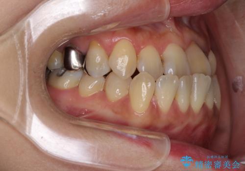 反対咬合で痛む前歯を改善 インビザラインによる矯正治療の治療前