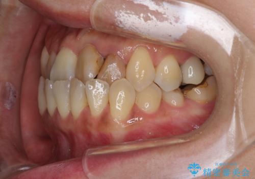 反対咬合で痛む前歯を改善 インビザラインによる矯正治療の治療前