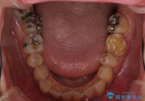 反対咬合で痛む前歯を改善 インビザラインによる矯正治療の治療前