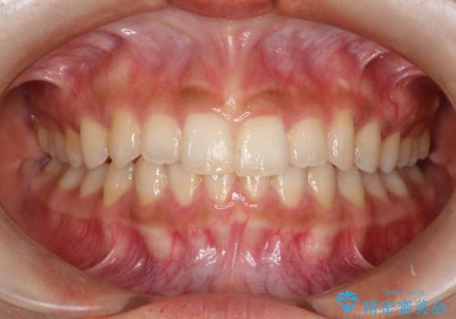 インビザラインを使用した深いかみ合わせの矯正の治療後