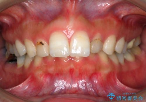 出っ歯を治したい 過蓋咬合