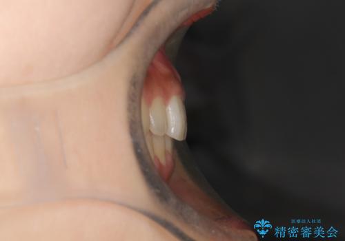 インビザラインを使用した深いかみ合わせの矯正の治療後