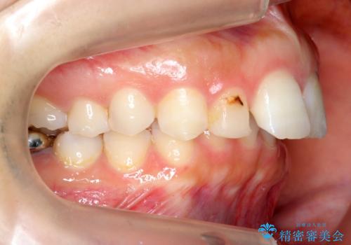 出っ歯を治したい 過蓋咬合の治療前