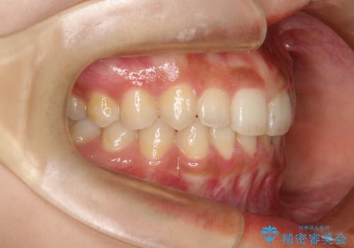 インビザラインを使用した深いかみ合わせの矯正の治療後