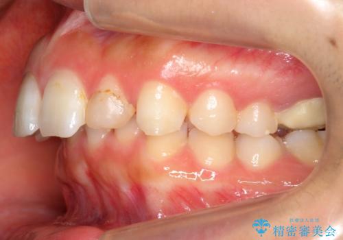 出っ歯を治したい 過蓋咬合の治療前