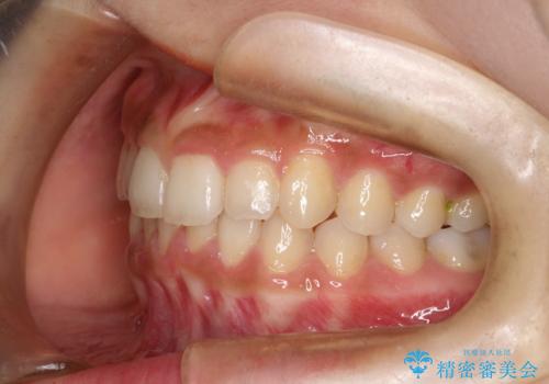 インビザラインを使用した深いかみ合わせの矯正の治療後