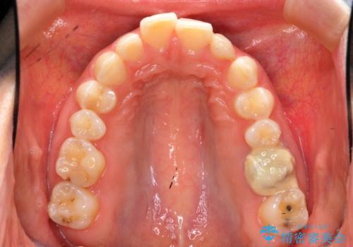 出っ歯を治したい 過蓋咬合の治療前