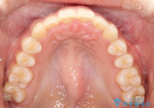 インビザラインを使用した深いかみ合わせの矯正の治療後