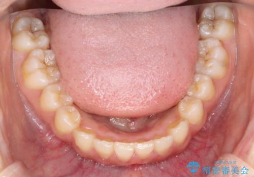 インビザラインを使用した深いかみ合わせの矯正の治療後