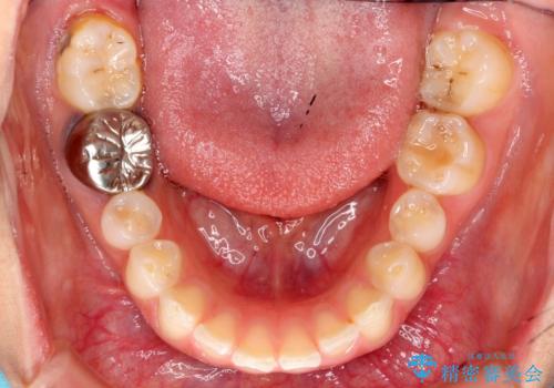 出っ歯を治したい 過蓋咬合の治療前