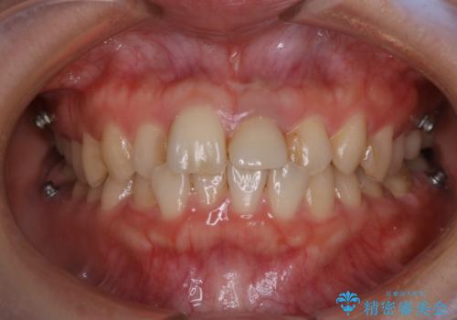 インビザラインのアタッチメントをつける前にPMTCの治療前