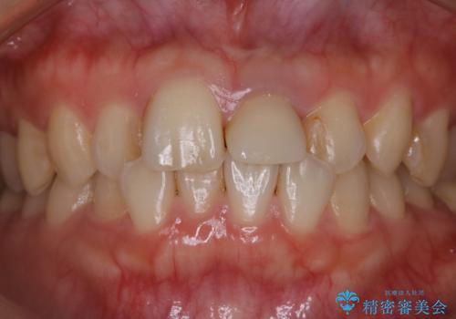 インビザラインのアタッチメントをつける前にPMTCの治療前