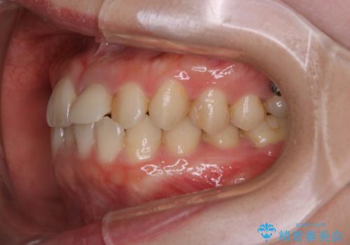 インビザラインのアタッチメントをつける前にPMTCの治療前