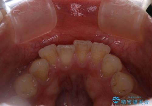 インビザラインのアタッチメントをつける前にPMTCの治療前