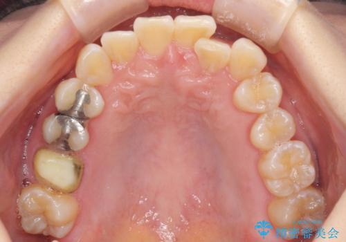 前歯のクロスバイト インビザライン矯正で改善の治療前