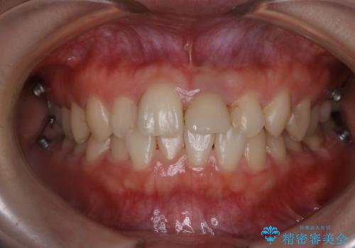 インビザラインのアタッチメントをつける前にPMTCの治療後