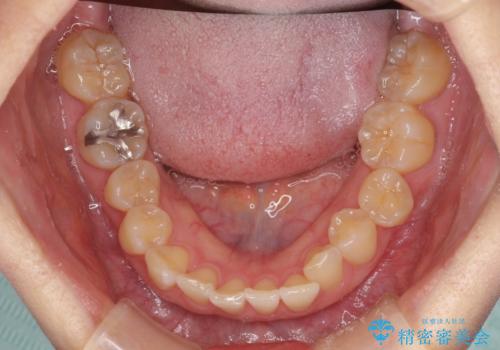 前歯のクロスバイト インビザライン矯正で改善の治療前