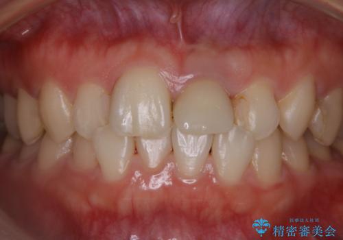 インビザラインのアタッチメントをつける前にPMTCの治療後