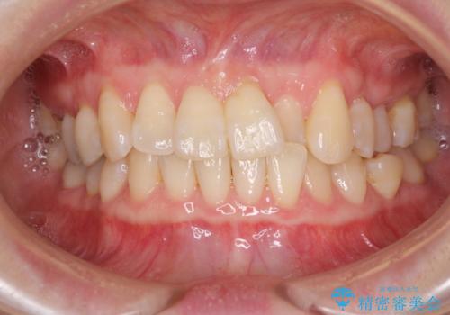 前歯のクロスバイト　インビザライン矯正で改善の症例 治療前