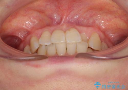 前歯のクロスバイト インビザライン矯正で改善の治療前