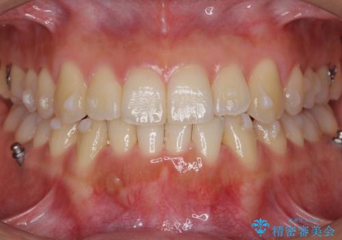 前歯のがたつき インビザラインで 下の奥歯を後ろに下げるの治療中
