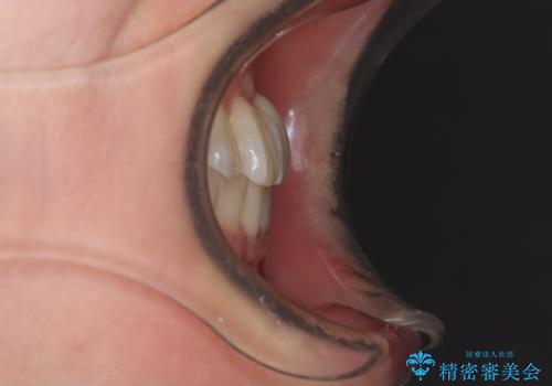 前歯のクロスバイト インビザライン矯正で改善の治療前