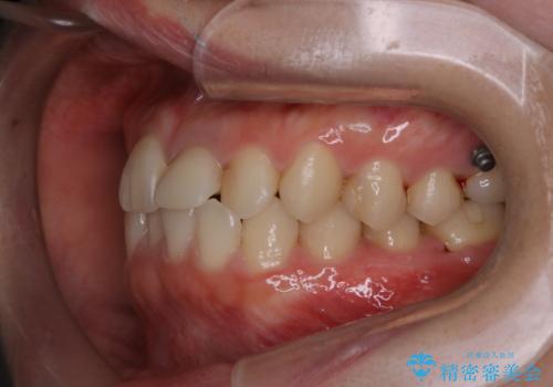 インビザラインのアタッチメントをつける前にPMTCの治療後