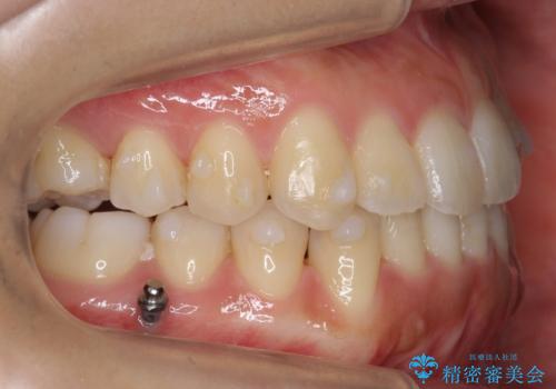 前歯のがたつき　インビザラインで　下の奥歯を後ろに下げるの治療中