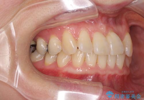 前歯のクロスバイト インビザライン矯正で改善の治療前