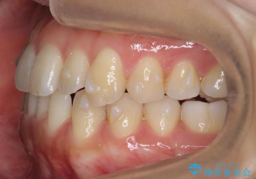 前歯のがたつき インビザラインで 下の奥歯を後ろに下げるの治療中