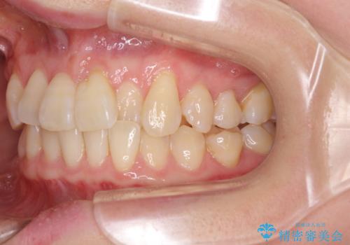 前歯のクロスバイト インビザライン矯正で改善の治療前